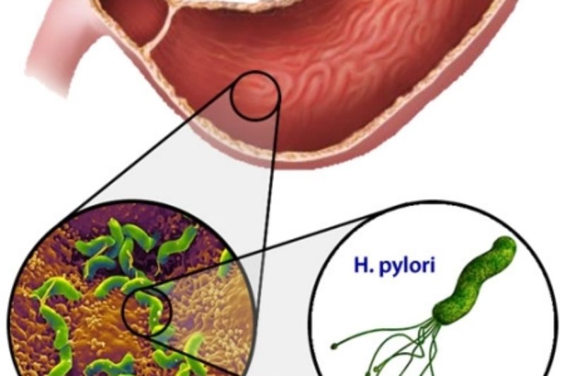 Helicobacter Pylori ve Fonksiyonel Tıp Tedavisi